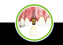 dental implants in bethesda md